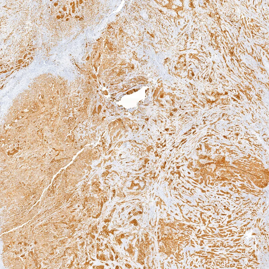 A routine IHC tissue section, with a tissue classification map and then a biomarker heatmap drawn over it
