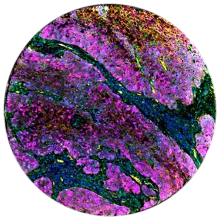 Tumour core in multiplex immunofluorescence, magenta epithelium threaded with green stroma