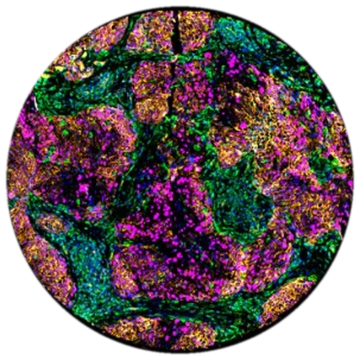 Tumour core in multiplex immunofluorescence, amber and magenta tumour nests in a green stromal mesh